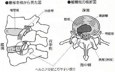 坐骨神経痛の図2