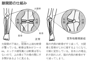 変形性膝関節症