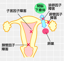 子宮での障害